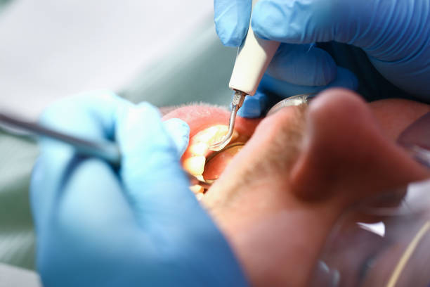 Best Emergency Tooth Extraction in Doolittle, TX